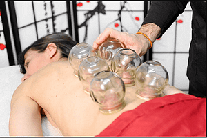 The Benefits of Cupping