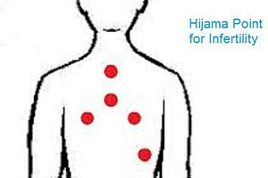 Hijama and Infertility: Can Cupping Therapy Help?