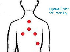 Read more about the article Hijama and Infertility: Can Cupping Therapy Help?
